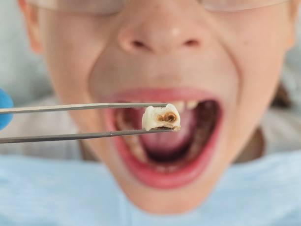 Best Emergency Wisdom Teeth Removal in Succasunna, NJ